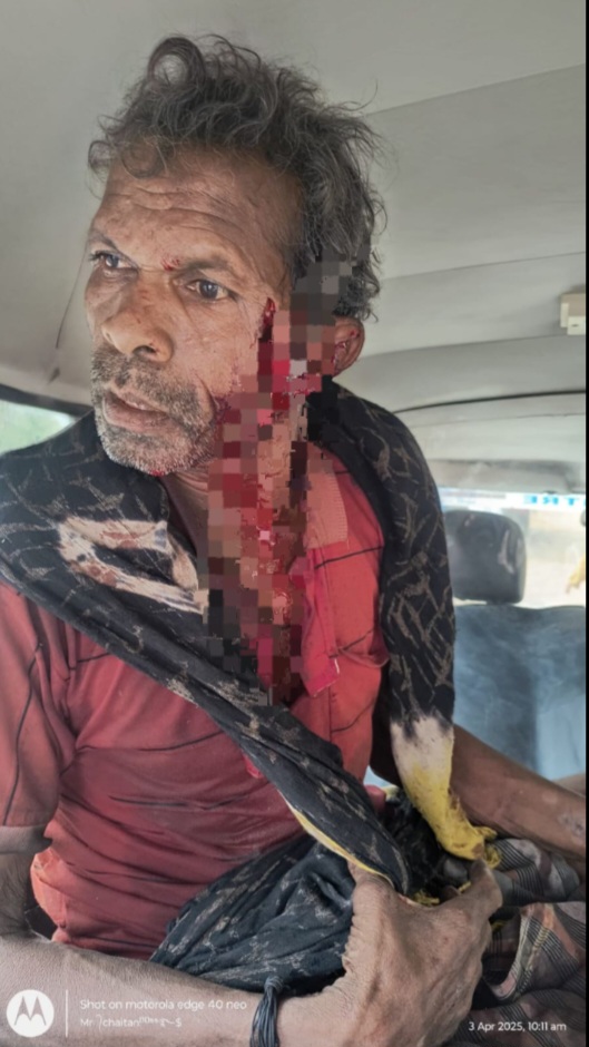 जंगली सुअर के हमले में व्यक्ति गंभीर रूप से घायल, रायगढ़ मेडिकल कॉलेज रेफर